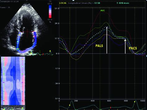 Left Atrial Longitudinal Strain Parameters Composite Figure Showing