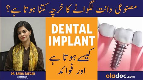 Dental Implant Procedure Mansoi Dant Lagane Ka Tarika Dental