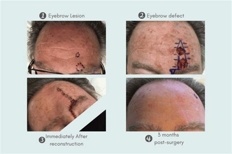 Mohs Surgery In Scottsdale And Paradise Valley Skin Cancer Surgery