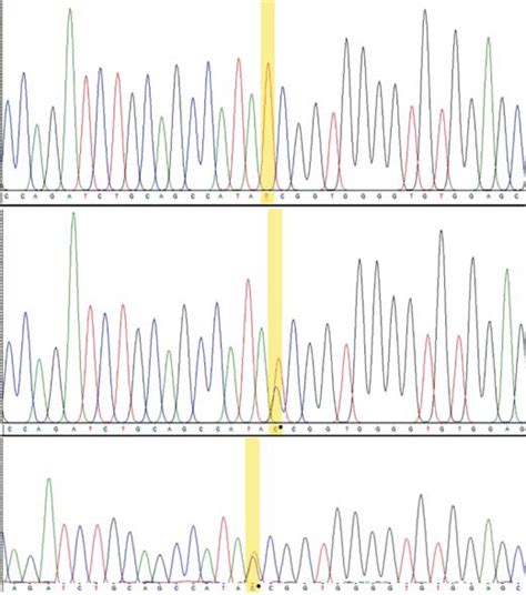 Sequence Chromatograms Showing The Novel ECEL1 Variant In A Homozygous