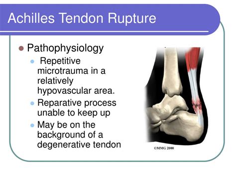 Ppt Achilles Tendon Disorders Powerpoint Presentation Free Download Id 149052