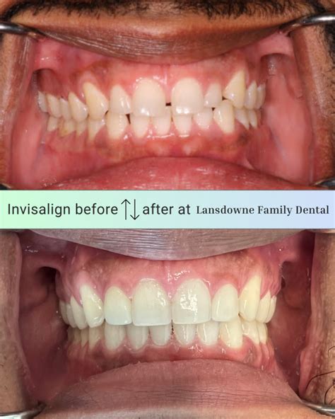 Invisalign Before And After