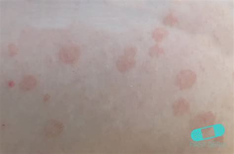 Online Dermatology Pityriasis Rosea