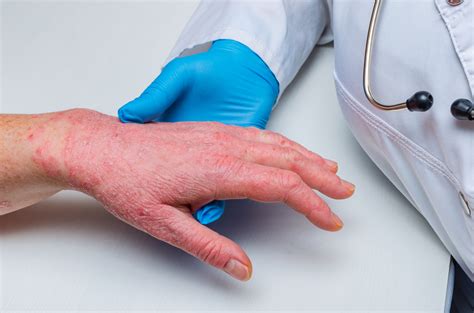 3 Major Differences Between Psoriasis And Eczema Pennsylvania