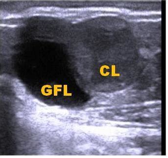 Ultrasonographic Image Of A Graafian Follicle Gfl And Corpus Luteum