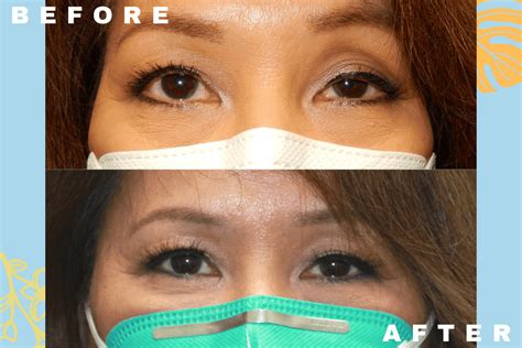 Ptosis Repair Honolulu Eyelid Surgery Oahu The Oculoplastics Center