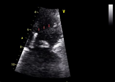 A Supra Aortic Membrane Without Any Aortic Leak Download Scientific Diagram