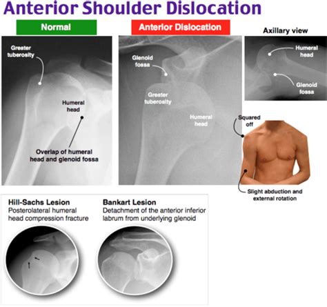 Shoulder Dislocation Flashcards | Quizlet