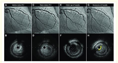 Serial Coronary Angiogram And Intravascular Ultrasound Images Coronary