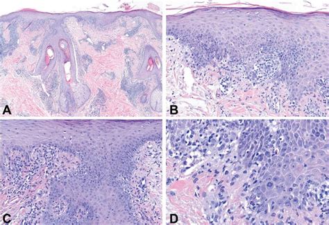 H&E sections show a lichenoid interface dermatitis with prominent and ...