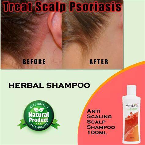 Dry Scalp Psoriasis