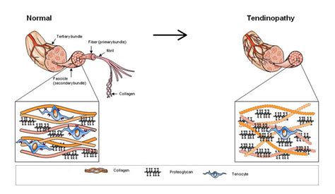 Chronic Tendon Damage Ankle Foot And Orthotic Centre