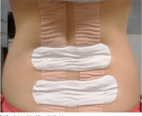 Figure 1 From The Immediate Effects Of Kinesiology Taping On Cutaneous