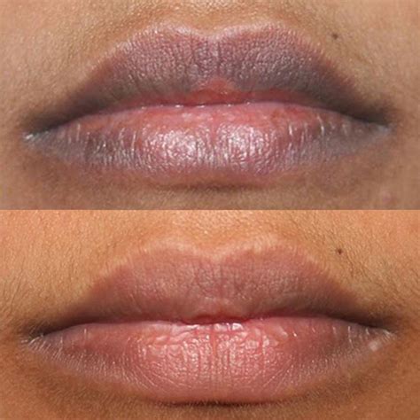 Lip Hyperpigmentation Causes Informacionpublica Svet Gob Gt