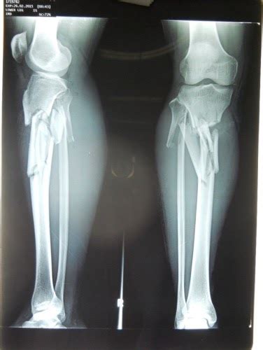 Orthopaedi Knowledges: MANAGEMENT OF LONG BONE FRACTURES