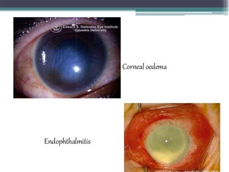 Corneal Ulcers