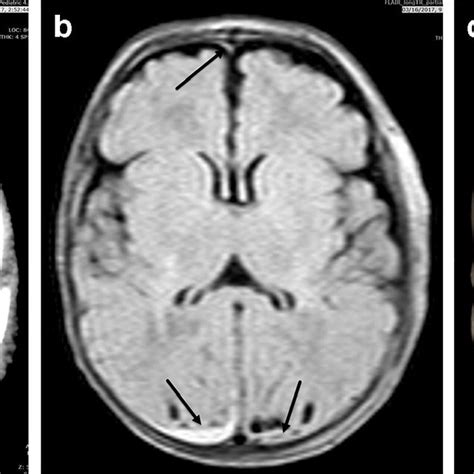 Abusive Head Trauma In A Month Old Boy A Sagittal Mri Of The Spine