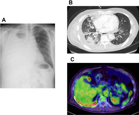 Figure 1 From A Case Of Pembrolizumab Induced Hemophagocytic