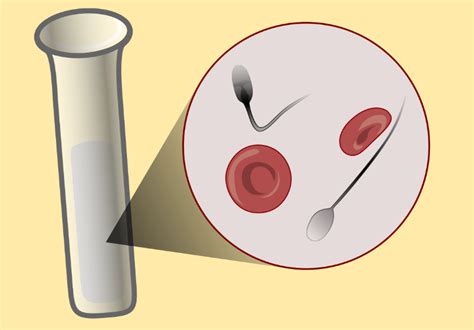 Blood In Semen Hemospermia Causes And Treatment Of Pathology