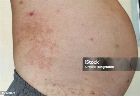 Mens Belly Rash Hives Itchy On The Body The Waistline Of The Fat People