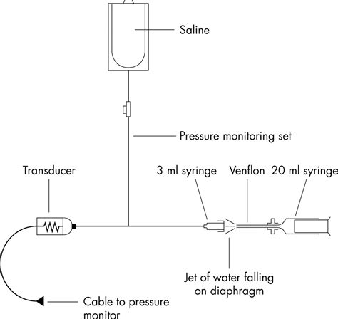 Foreign Bodies In The Ear A Simple Technique For Removal Analysed In Vitro Emergency Medicine