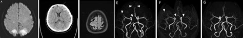 Reversible Cerebral Vasoconstriction Syndrome (RCVS) - EMCrit Project