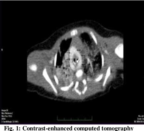 Figure 1 From A Double Aortic Arch Presenting With Respiratory Distress In A Newborn Infant