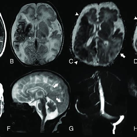 Brain MR Imaging Of Patient 2 Performed On Day 1 Axial T1 Weighted