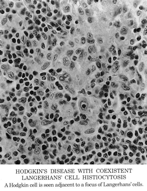 Pathology Outlines Langerhans Cell Histiocytosis