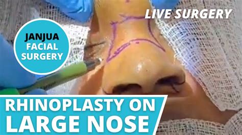 Rhinoplasty Osteotomy And Alarplasty Live Surgery Dr Tanveer