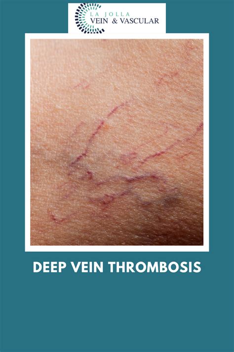 Deep Vein Thrombosis