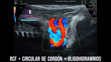 DOBLE CIRCULAR DE CORDON OLIGOHIDRAMNIOS RETRASO CRECIMIENTO FETAL