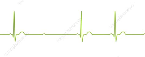 ECG with second degree Mobitz 2 AV block, illustration - Stock Image ...