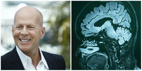 Bruce Willis Diagnosed With Frontotemporal Dementia What Does That