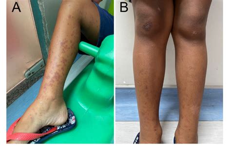 Right Lower Limb Purpuric Lesions Upon Admission A And Post Treatment Download Scientific