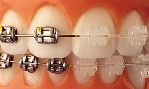 TIPOS DE BRACKETS Clínica Dental Fabián López