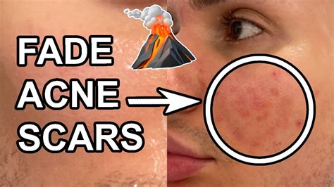 How To Get Rid Of Acne Scars In 2 Weeks Pih And Pie Best Products