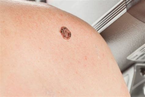 Melanoma Qué Es Tipos Causas Síntomas Y Tratamientos Para El