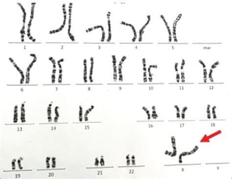 A Rare Differences Of Sex Development Male Sex Reversal Syndrome