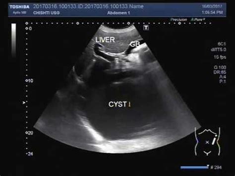 Ultrasound Video Showing A Large Cyst In Liver Youtube