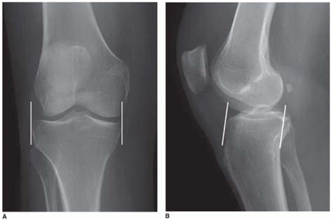 Medial Meniscal Transplant Musculoskeletal Key