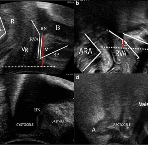 Two Dimensional Tpus Midsagittal Section Of Pelvic Organs A And B