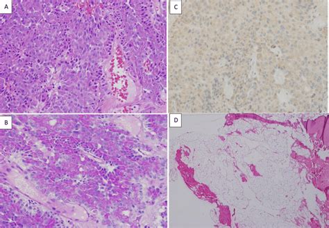 The H E Stain A Of The Pituitary Tumor Shows Sheets Of Monotonous