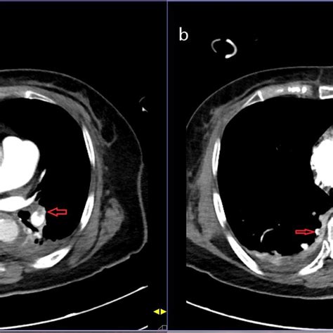 Computed Tomography Pulmonary Angiography Shows Extensive Thrombus