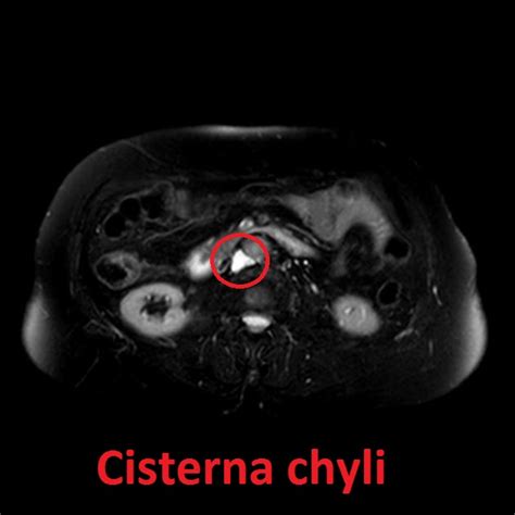 Cisterna Chyli