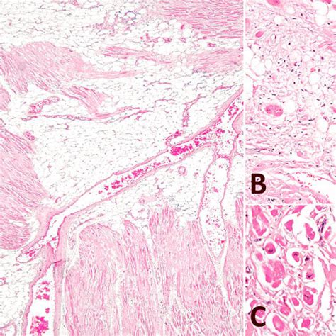 Pdf Lipomatous Hypertrophy Of The Interatrial Septum A Possibly