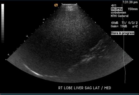 Fatty liver ultrasound - wikidoc