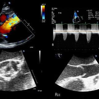 Transthoracic A B And Transesophageal C D Echocardiographic