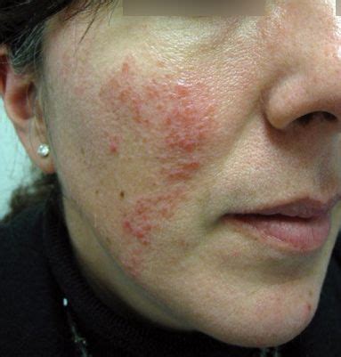 Facial Redness Rosacea Naked Photo