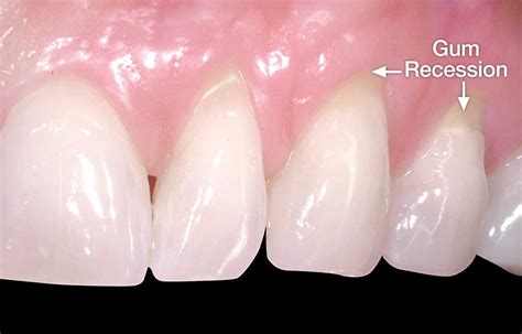 Gum Recession Coastal Periodontics Implant Dentistry Mobile Alabama